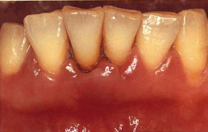 中等度の歯周病の様子